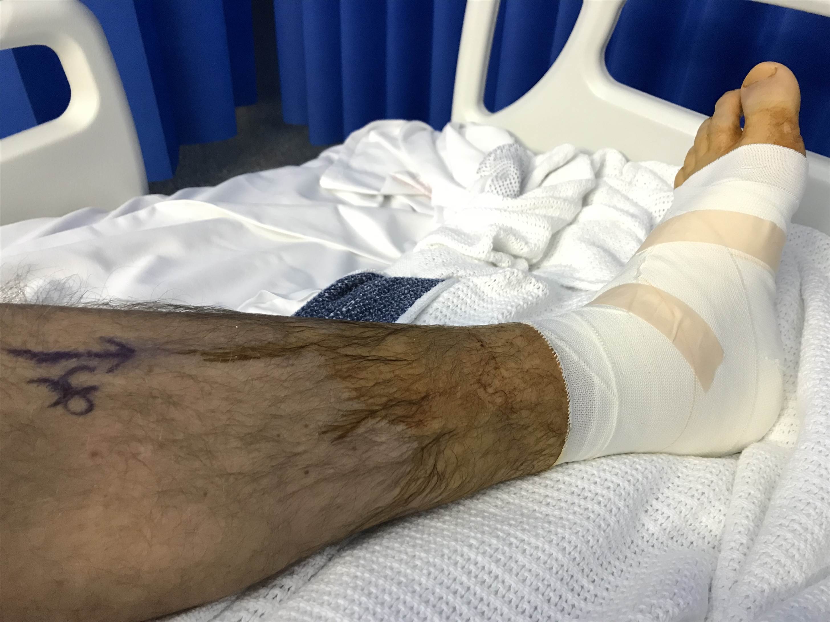 Surgery after breaking my ankle