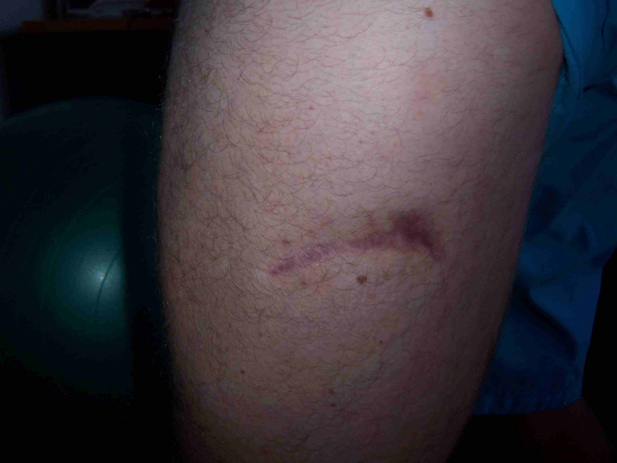 11 Months after stingray  barb.