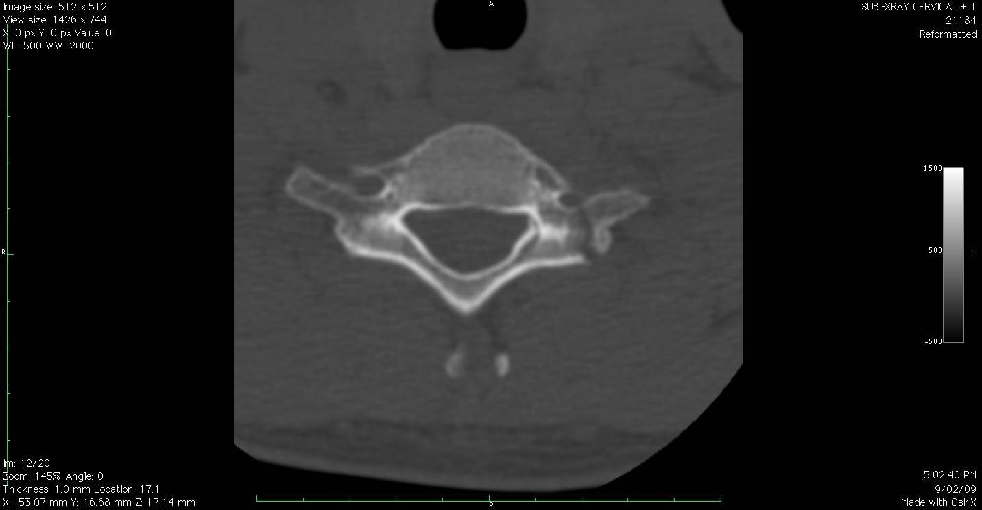 Broken chunk on the right hand side of the image