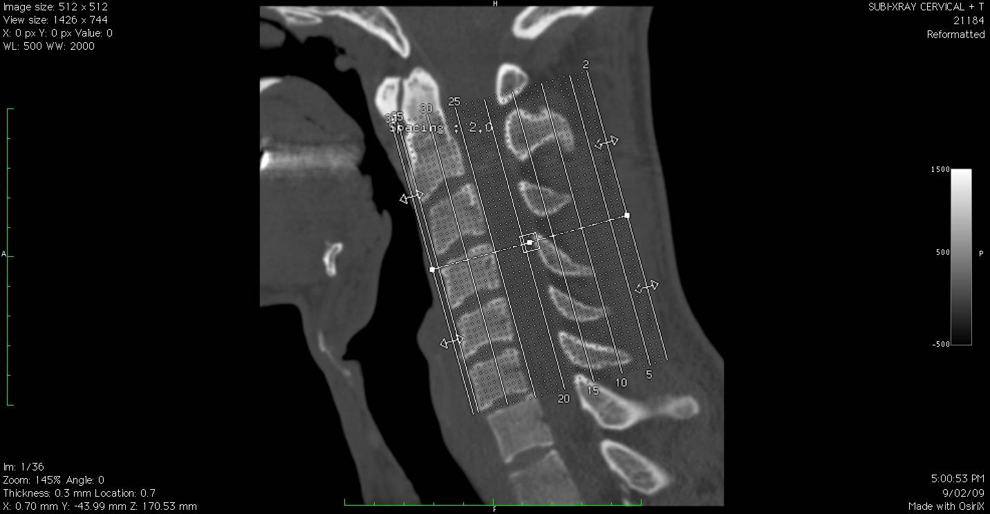 Displaced Spine at the bottom of the lines ( about 2mm)