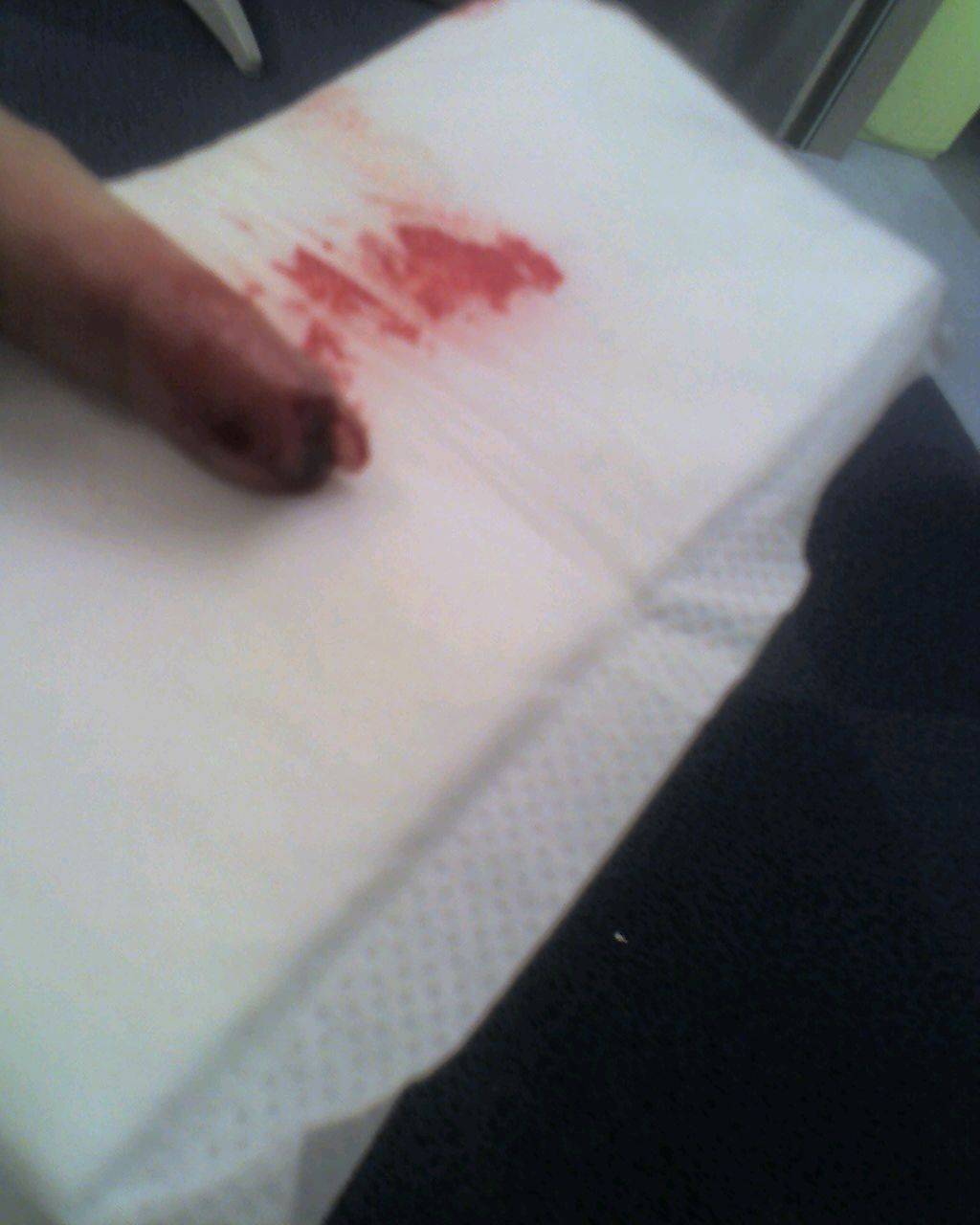 broke my nail kiting