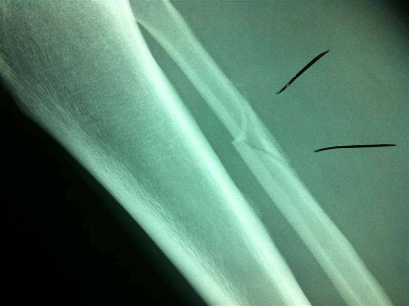 fibula