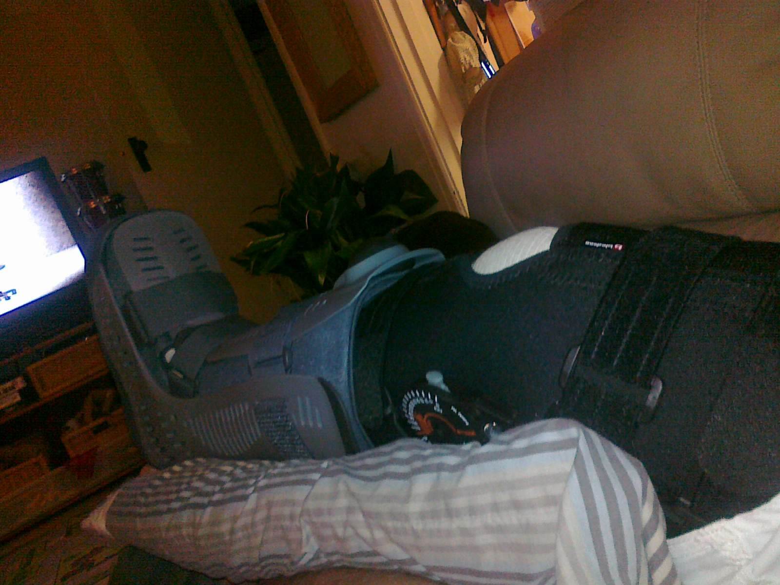 broken leg