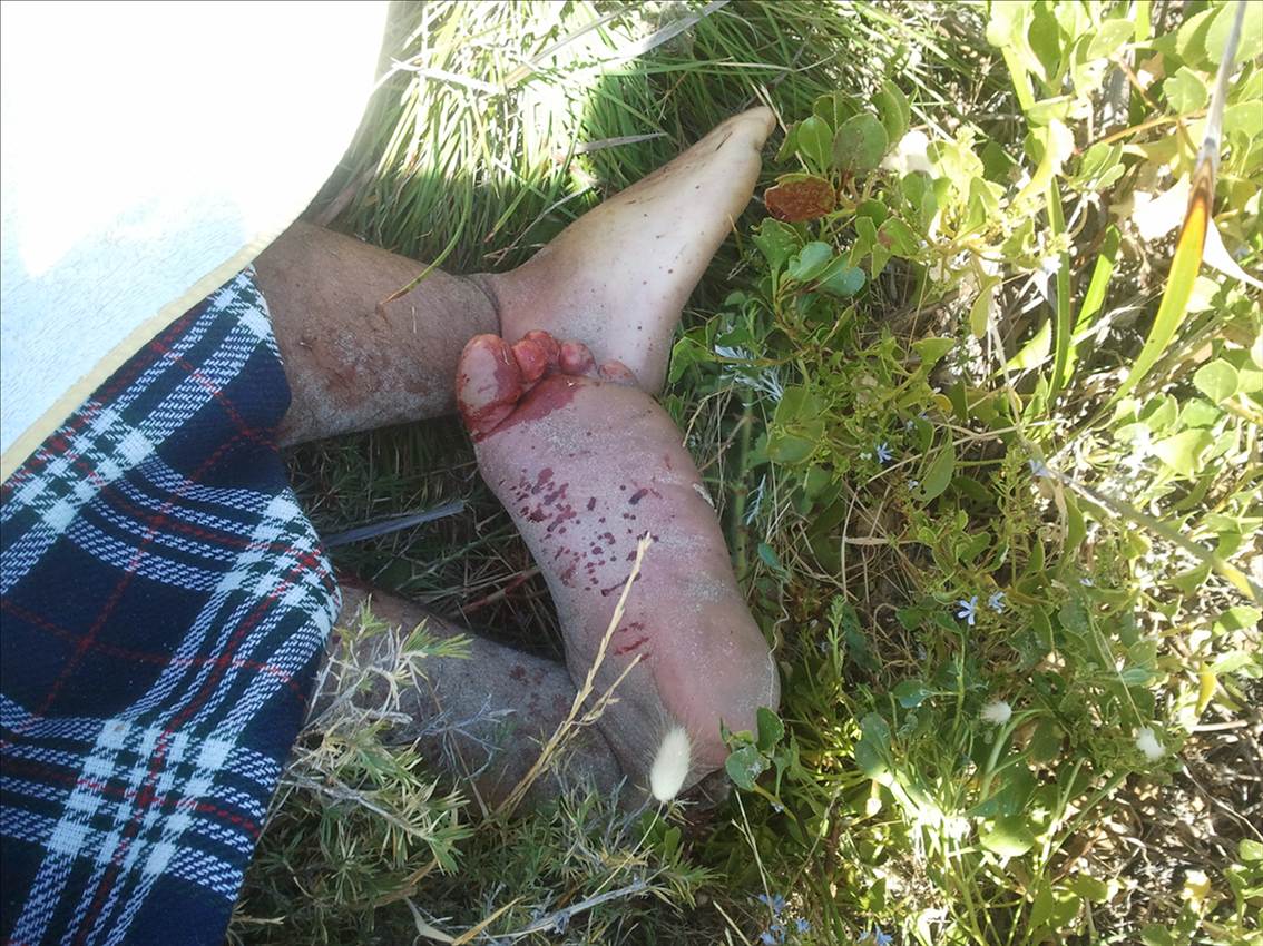 Kite boarding acident