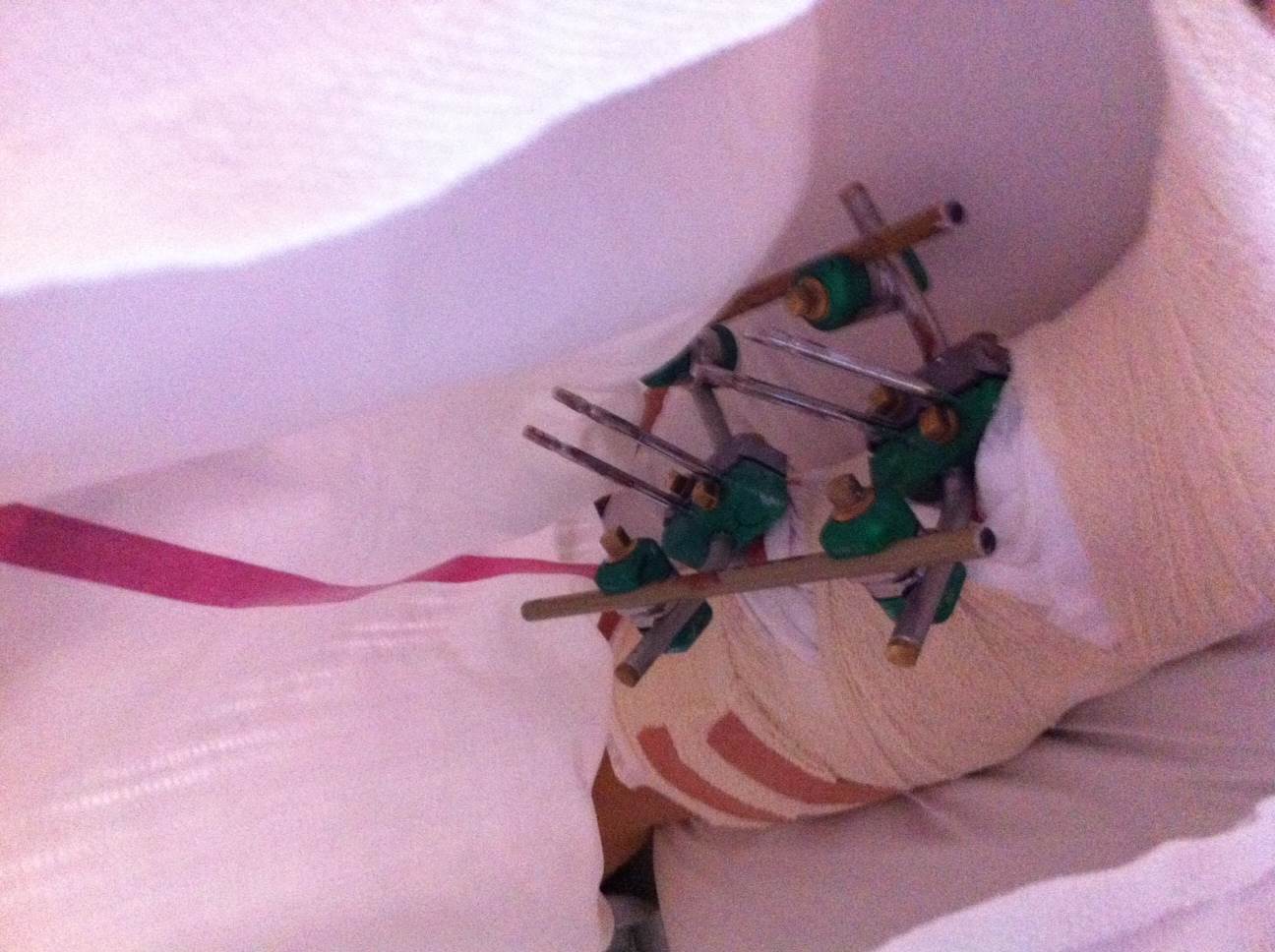 photo 2.JPG leg2