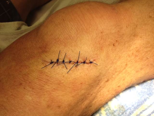 7 stitches