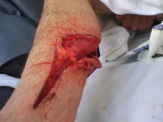 NSW kiter gets injured