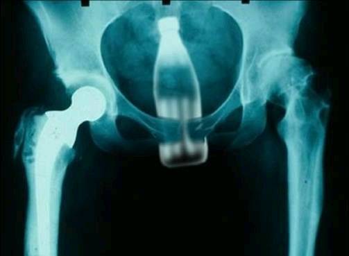 rectal FB