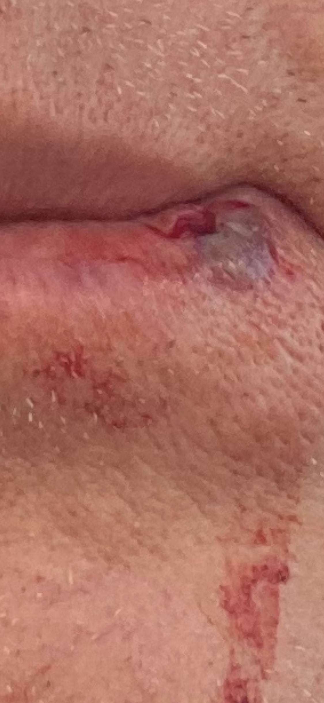 SPlit lip