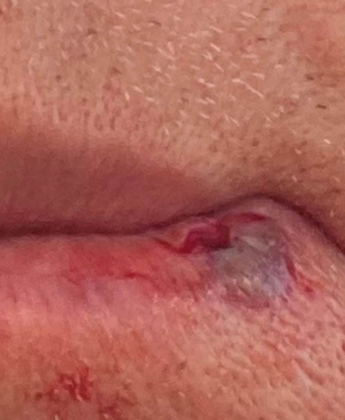 SPlit lip (3)