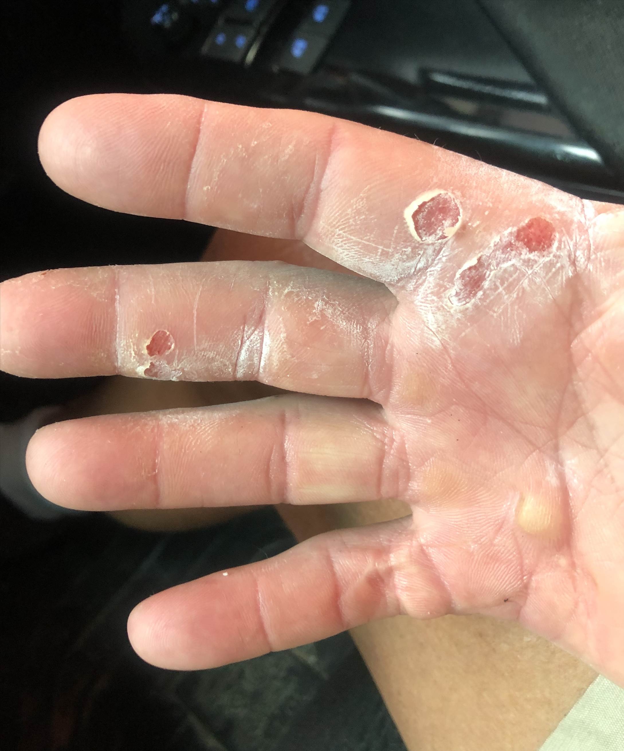 HAND 5