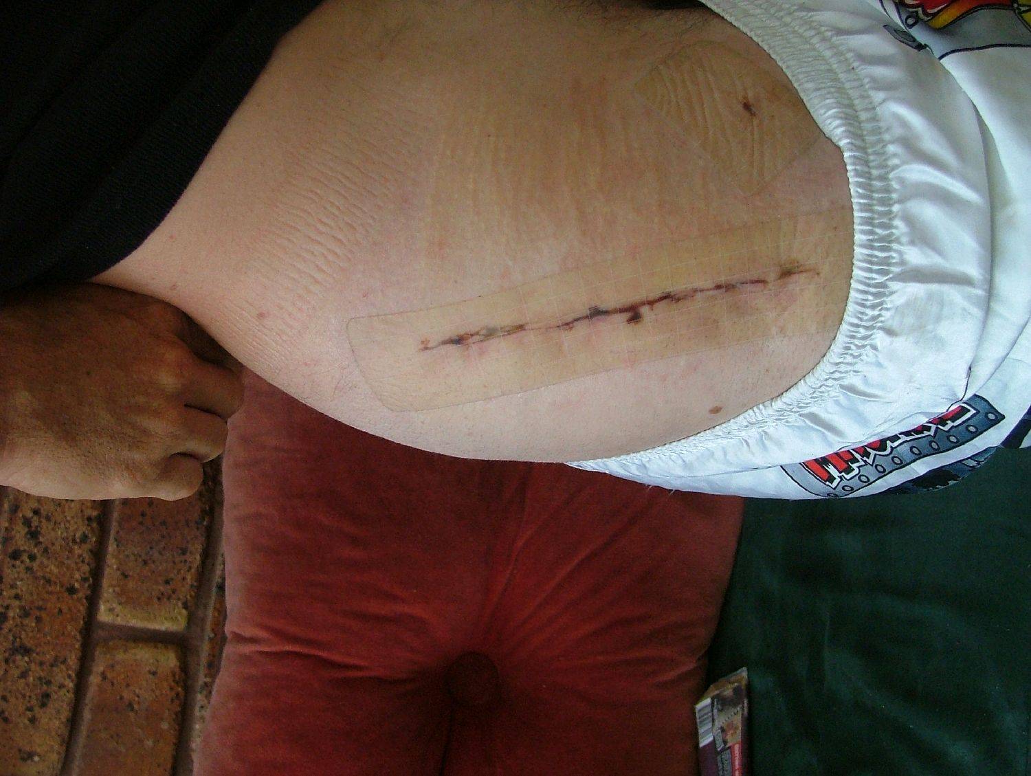 scar