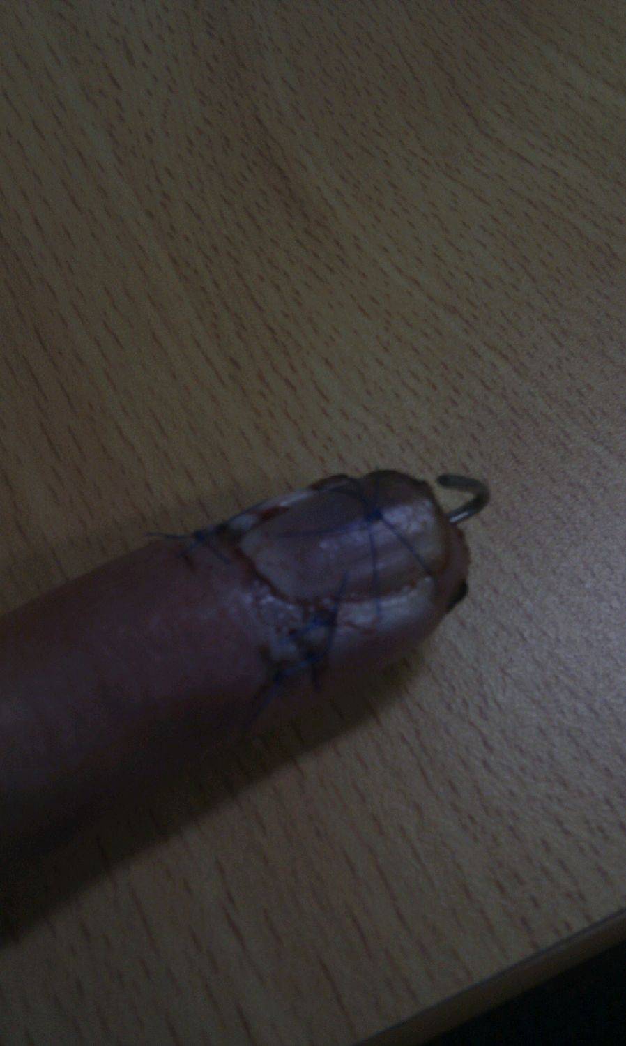 leg rope injury