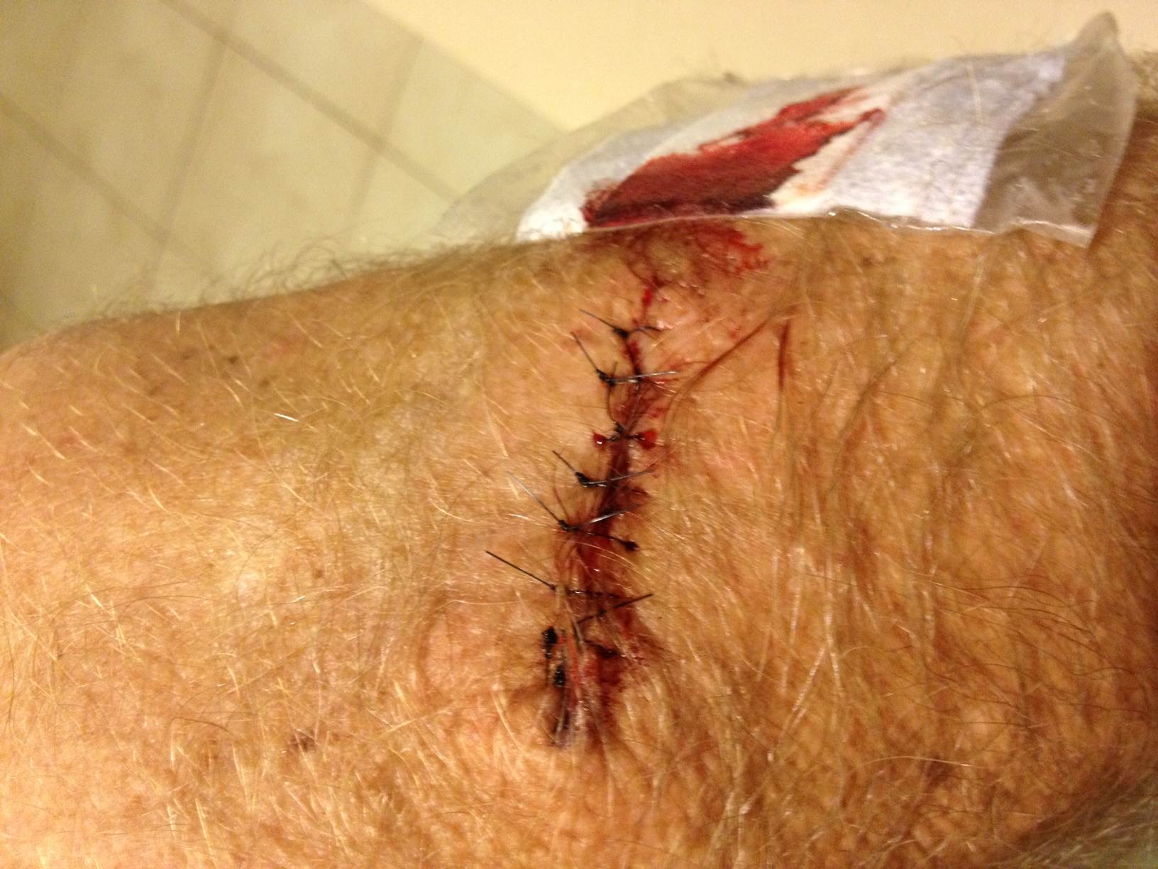 The aftermath of a BCC excision