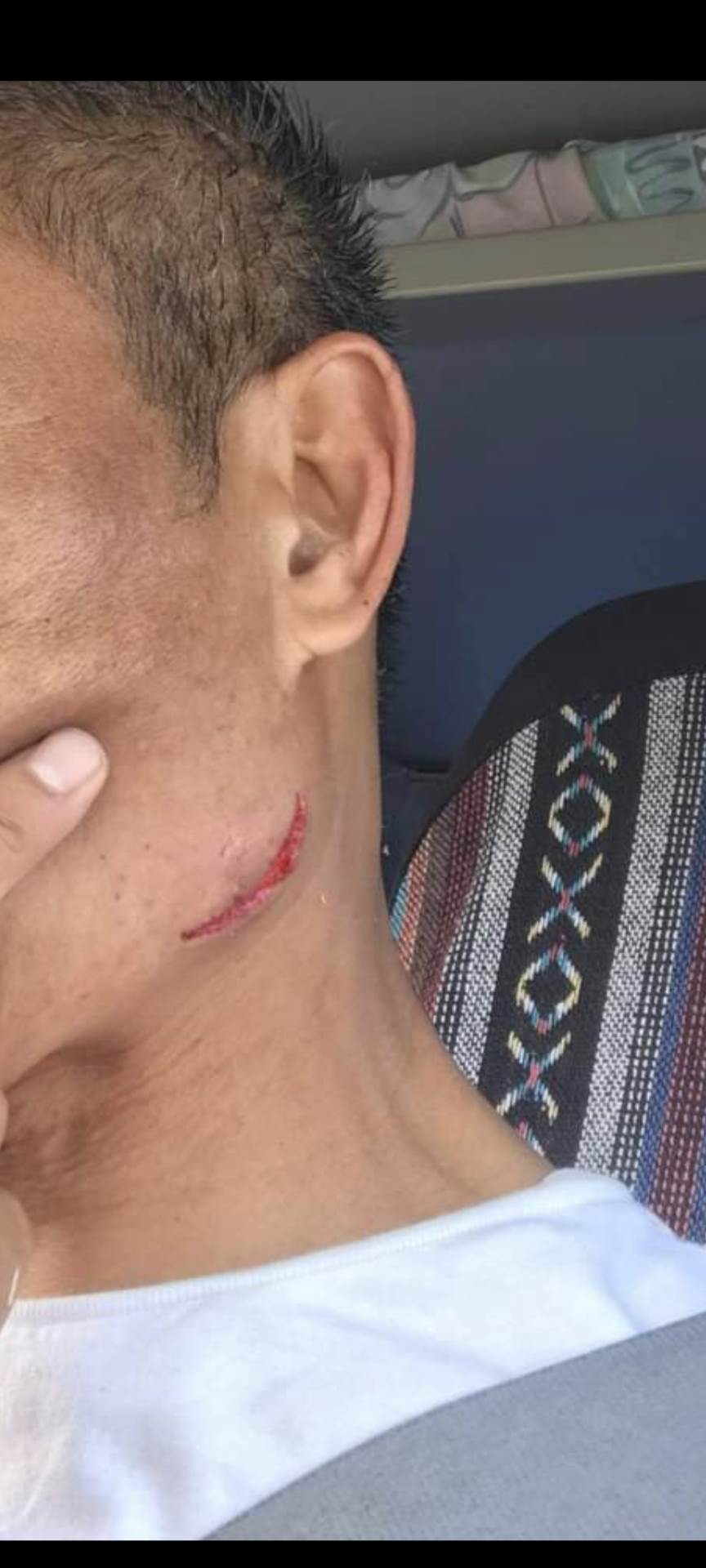 Laceration