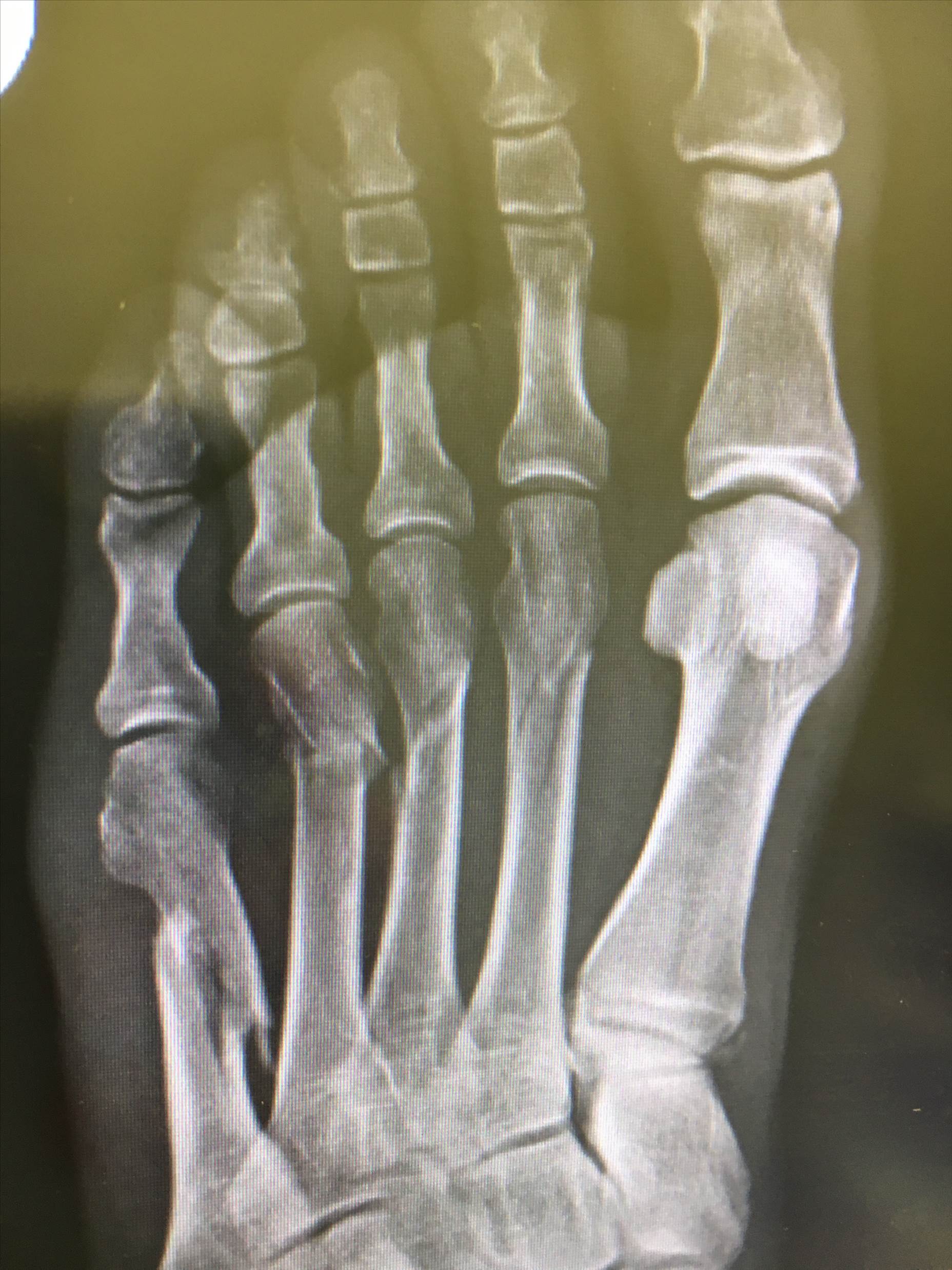 Foot