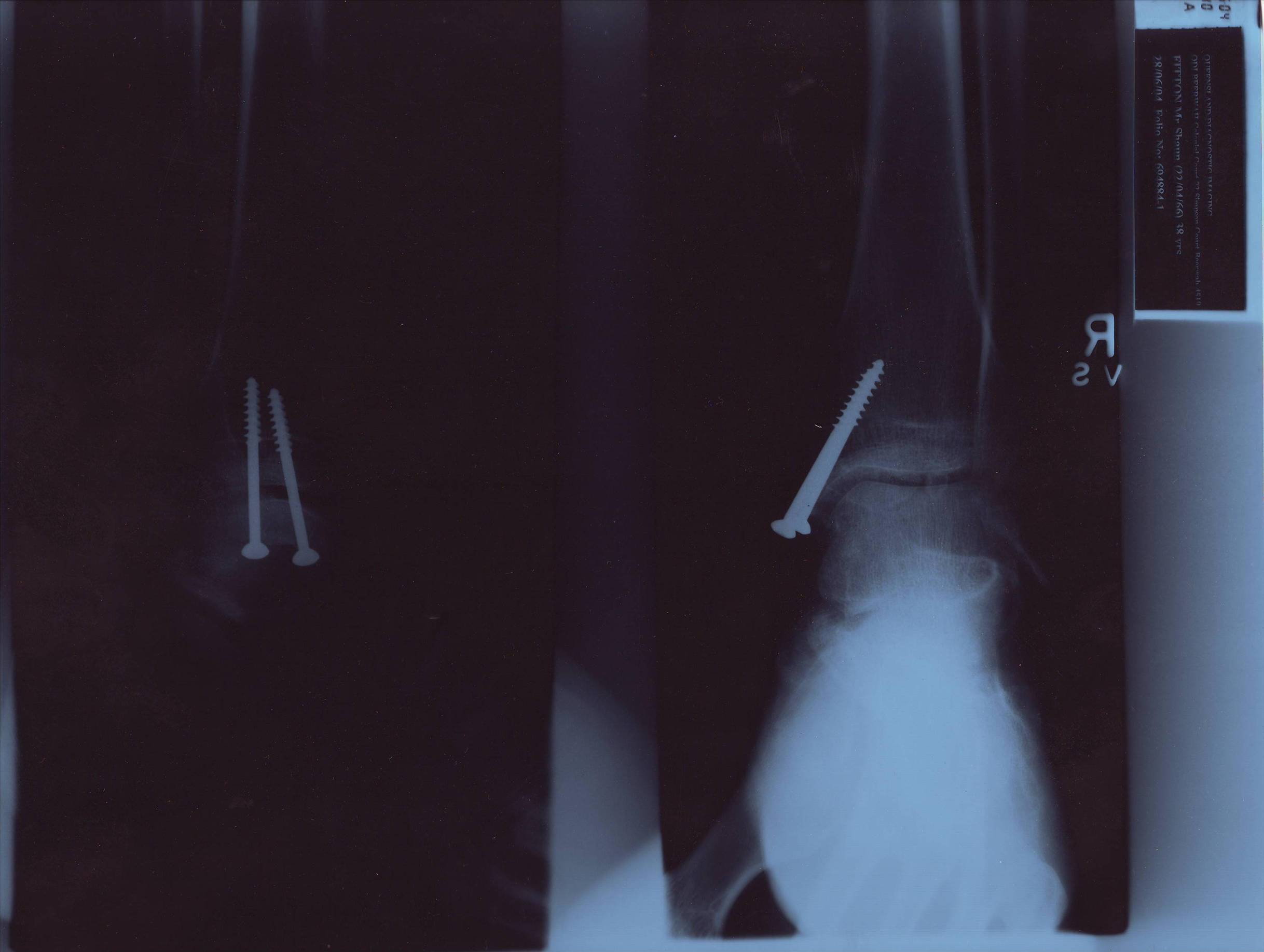 Screwed up ankle