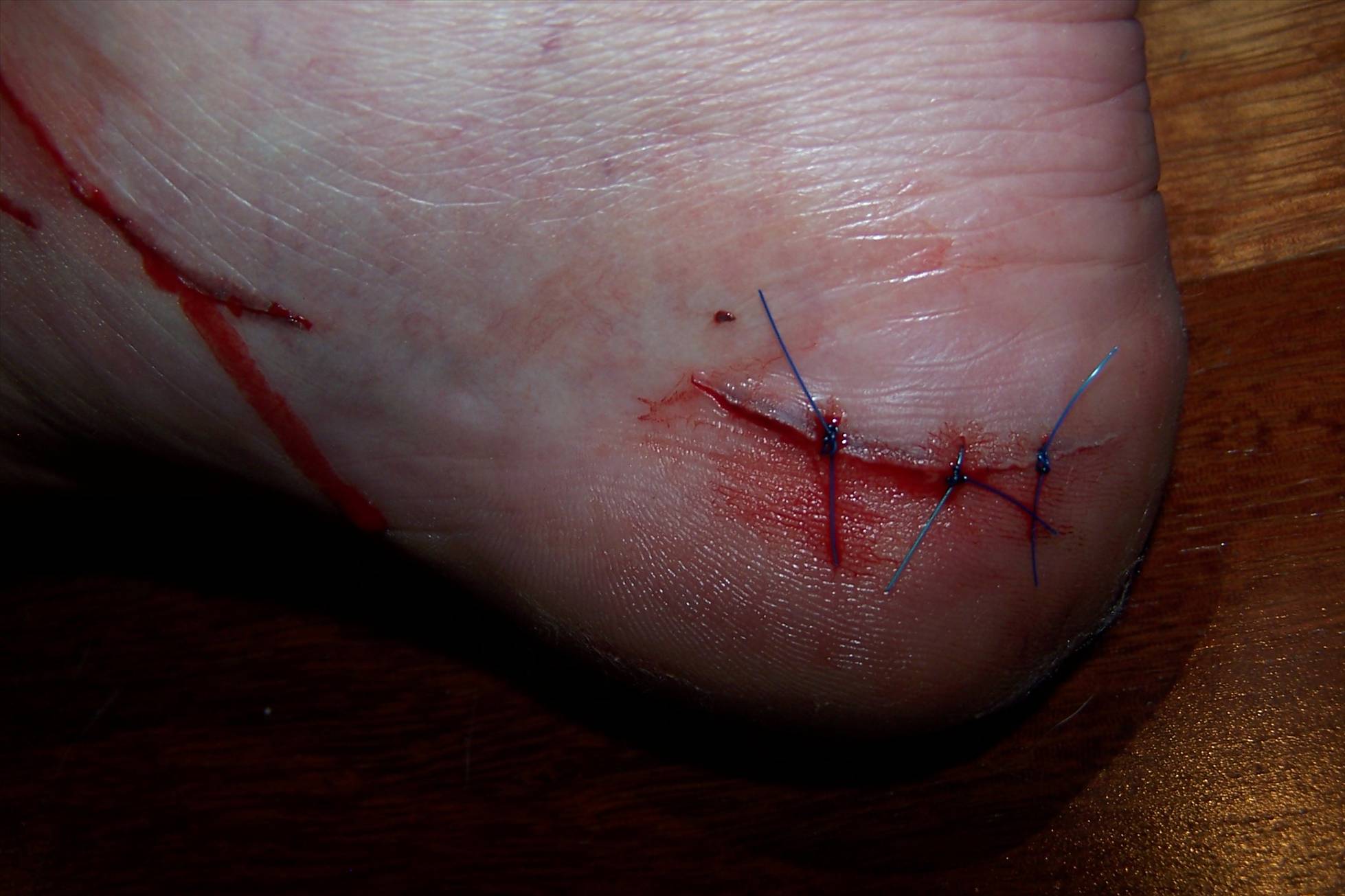 Fin Damage