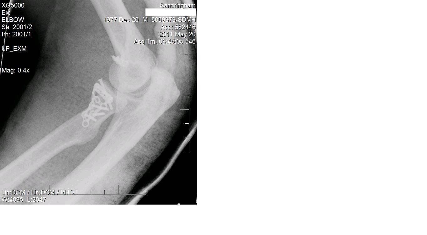 elbow