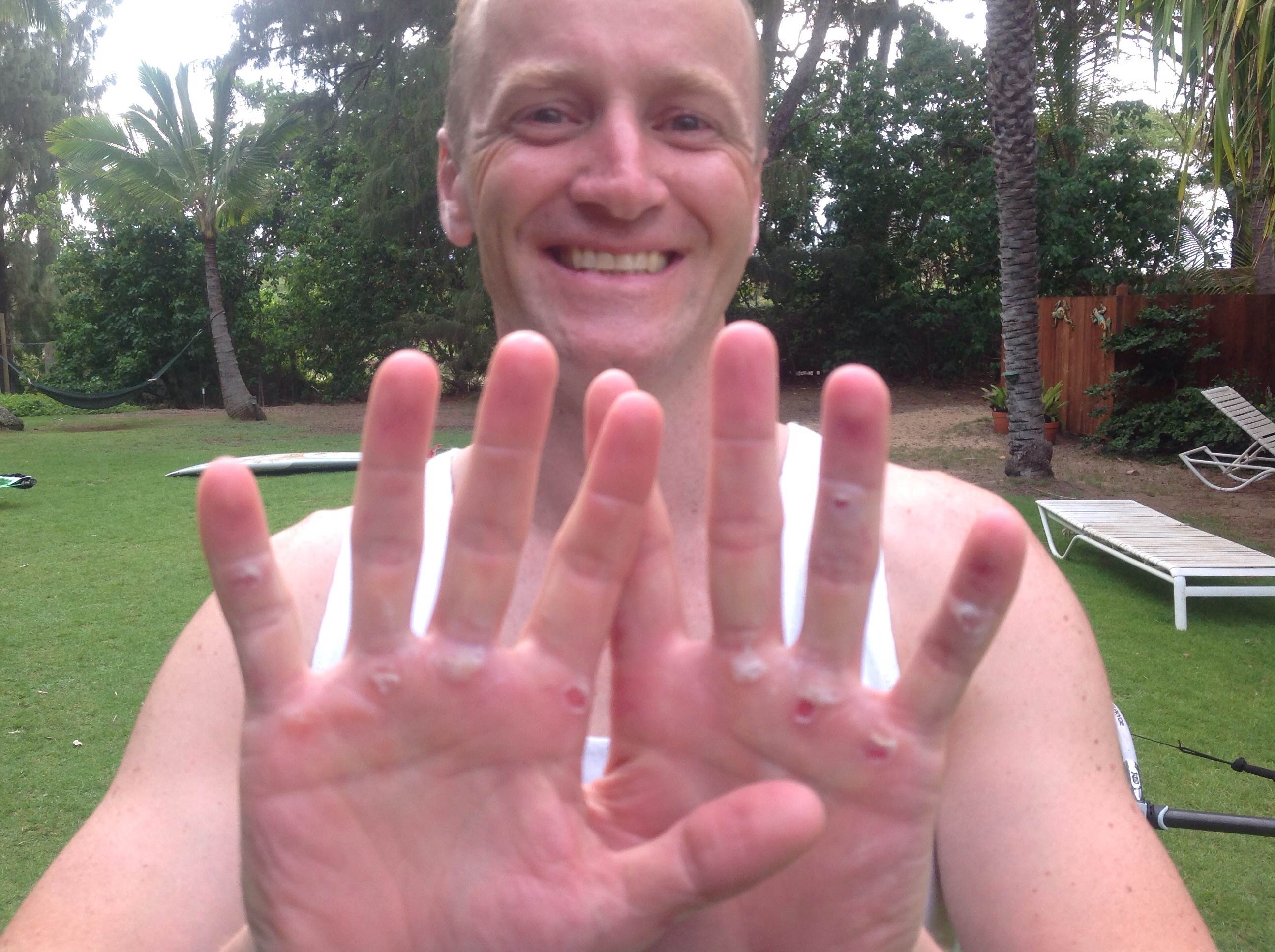 Sore hands