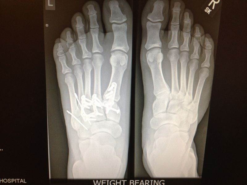 foot pain yes 186